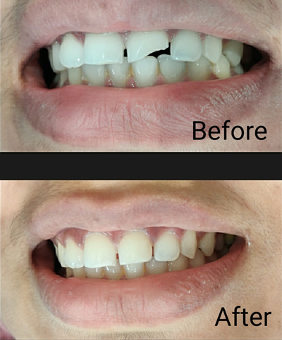 Tooth Filling